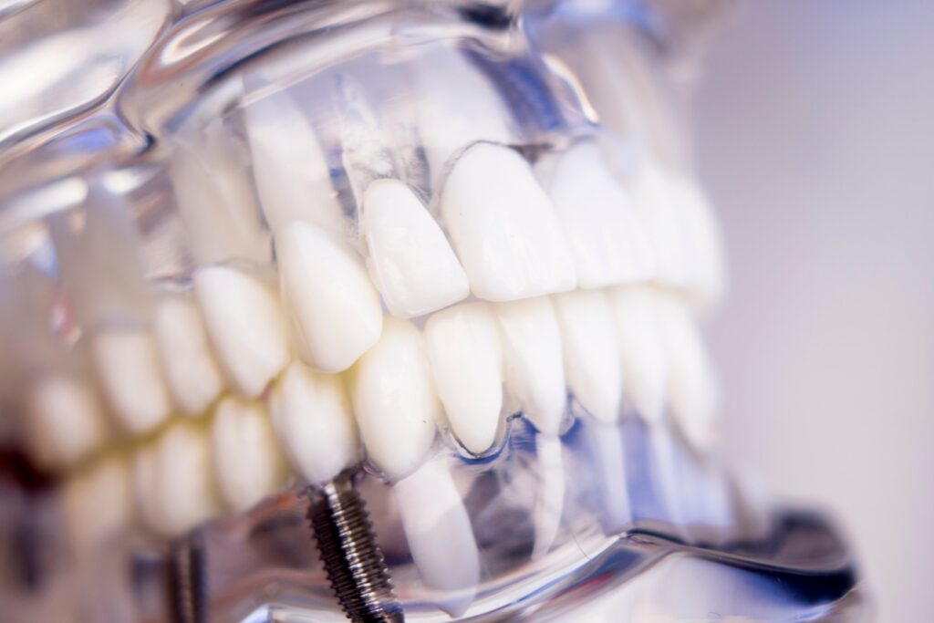 dental implants fleet dentist
